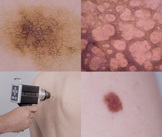 FotoFinder medicam1000